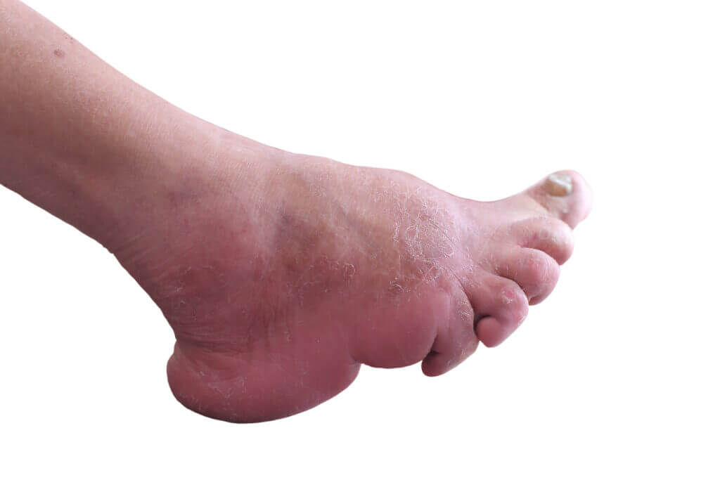 Close up of bound foot of a 97 years old Chinese old woman, born in 1919