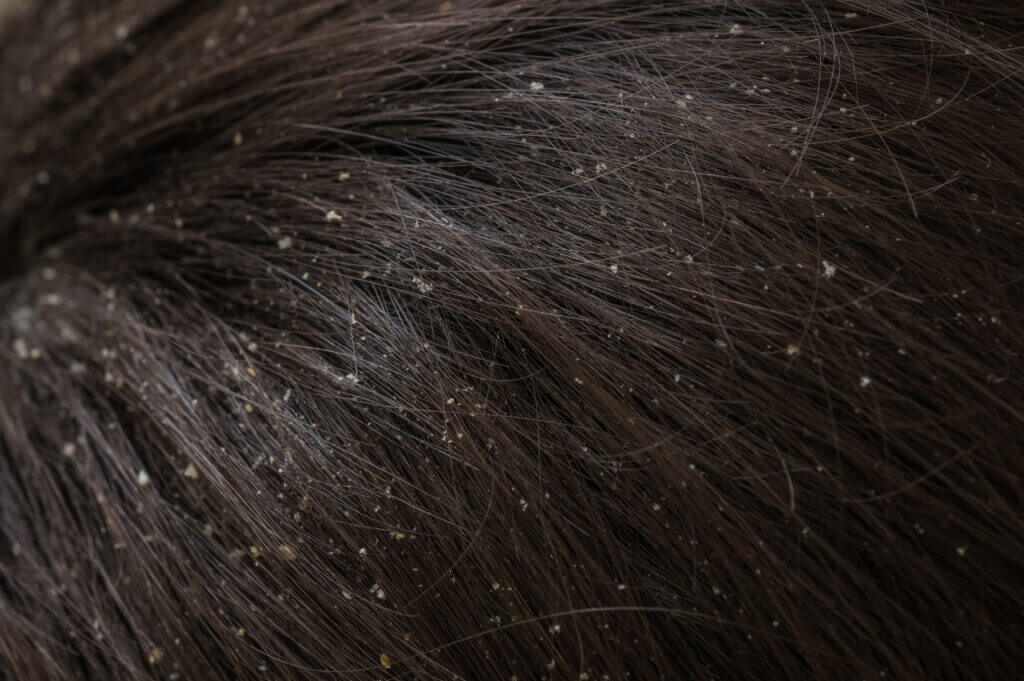 White dandruff flakes in dry hair