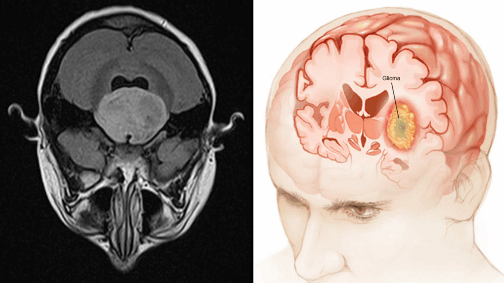Brain MRI and a diagram showing a glioma tumor.