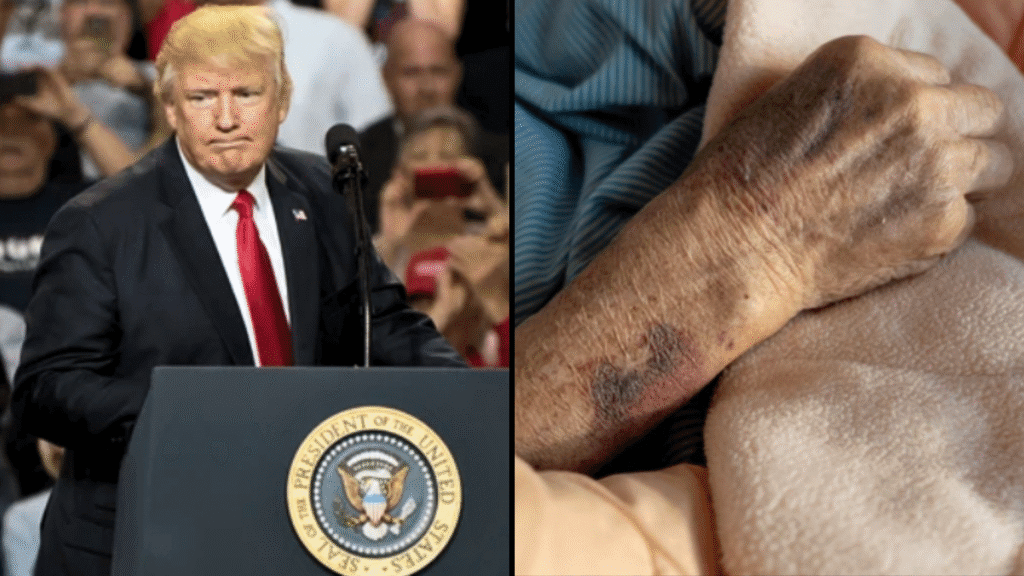 Donald Trump speaking at a podium with the presidential seal; close-up of a bruised arm resting on fabric.