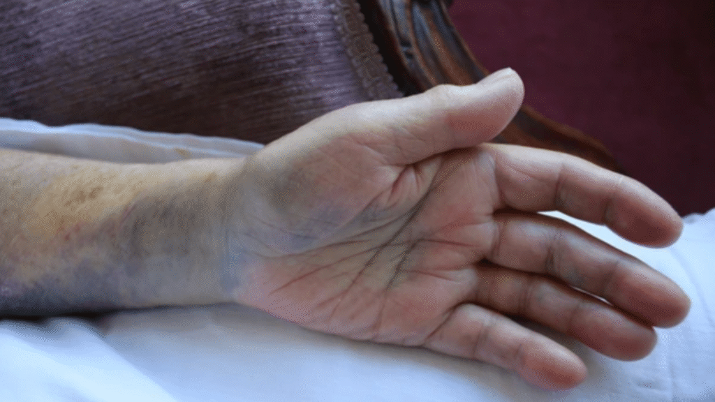 Close-up of a hand with visible bruising on the wrist and forearm.