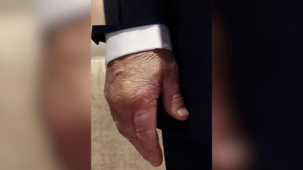 Close up of an older man’s hand hanging at his side, showing redness and swelling across the knuckles and back of the hand. Netizens claim it was covered by make up.
