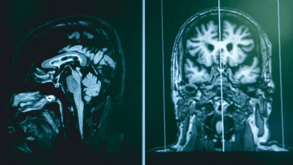 MRI brain scans displayed side by side showing cross-sectional views.