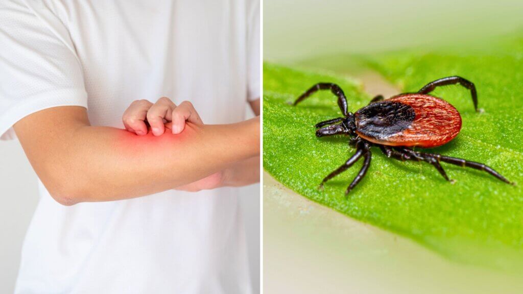 Tick Bite Leaves New Jersey Man Unable to Lift His Arms