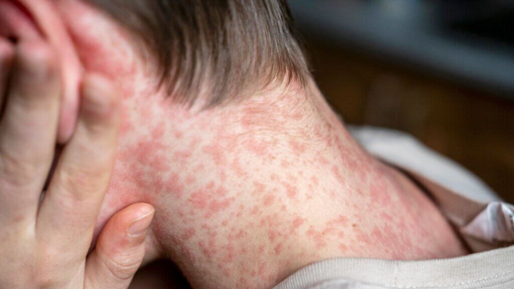 Teenager covered in measles rash