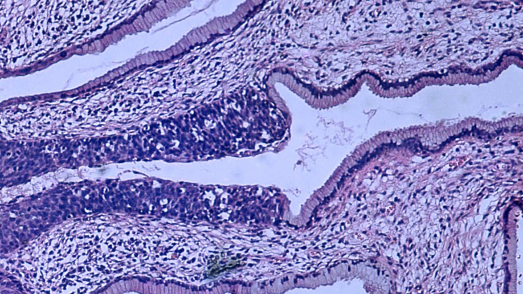 A high-power histopathological tissue slide under a microscope showing the cellular architecture of a cervical biopsy with severe epithelial dysplasia.