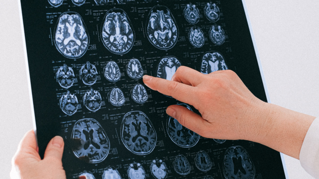 A medical professional in a white coat holds up a large sheet of black-and-white brain MRI scans, pointing their index finger at a specific cross-section image.