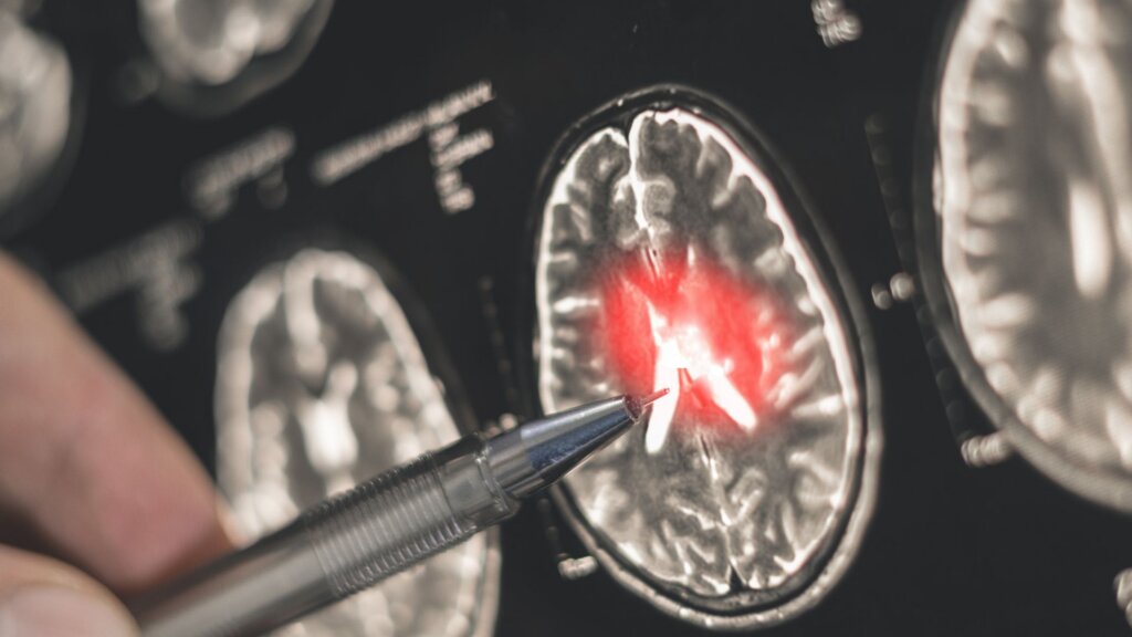 An image showing a doctor using a pen to examine a brain X-ray for signs of Alzheimer’s disease.