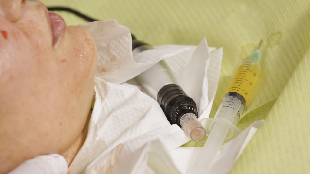 Close-up of a facial skin treatment setup with a microneedling pen and a syringe.