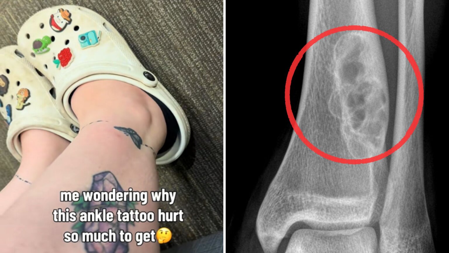 Split image of Skylar’s butterfly ankle tattoo and an X-ray highlighting the bone lesion beneath it.