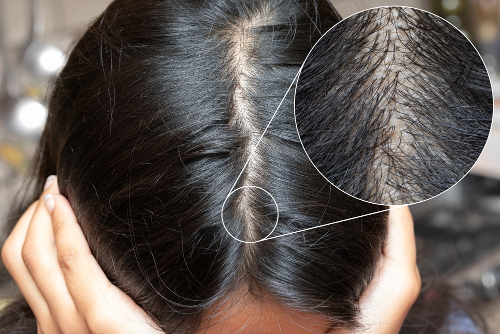 Thinning hair along a woman’s scalp with an inset close-up showing sparse hair growth.