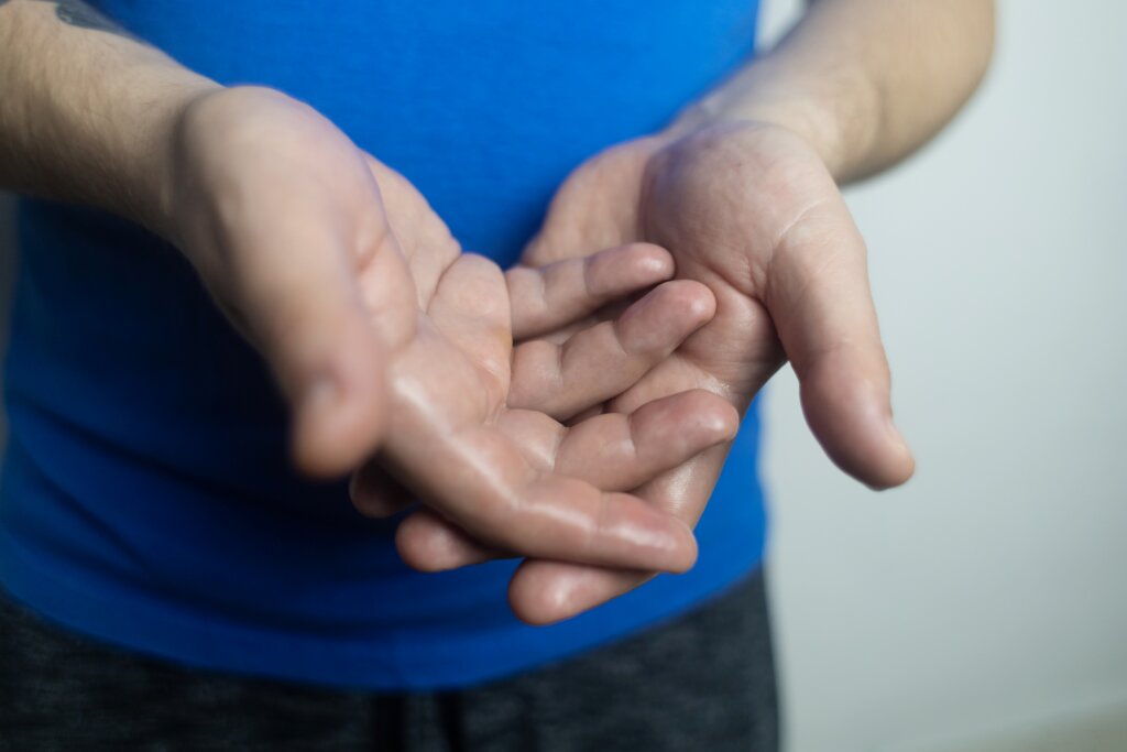 Close-up of noticeably sweaty palms, a common sign of excessive sweating or hyperhidrosis.