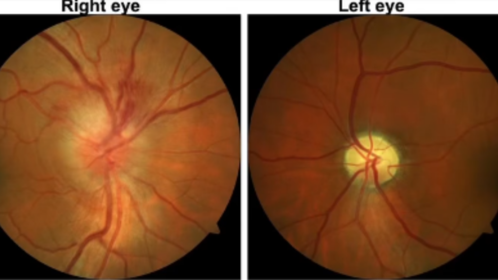 Side-by-side images of an eye, highlighting different retinal damage types associated with sudden vision impairment.