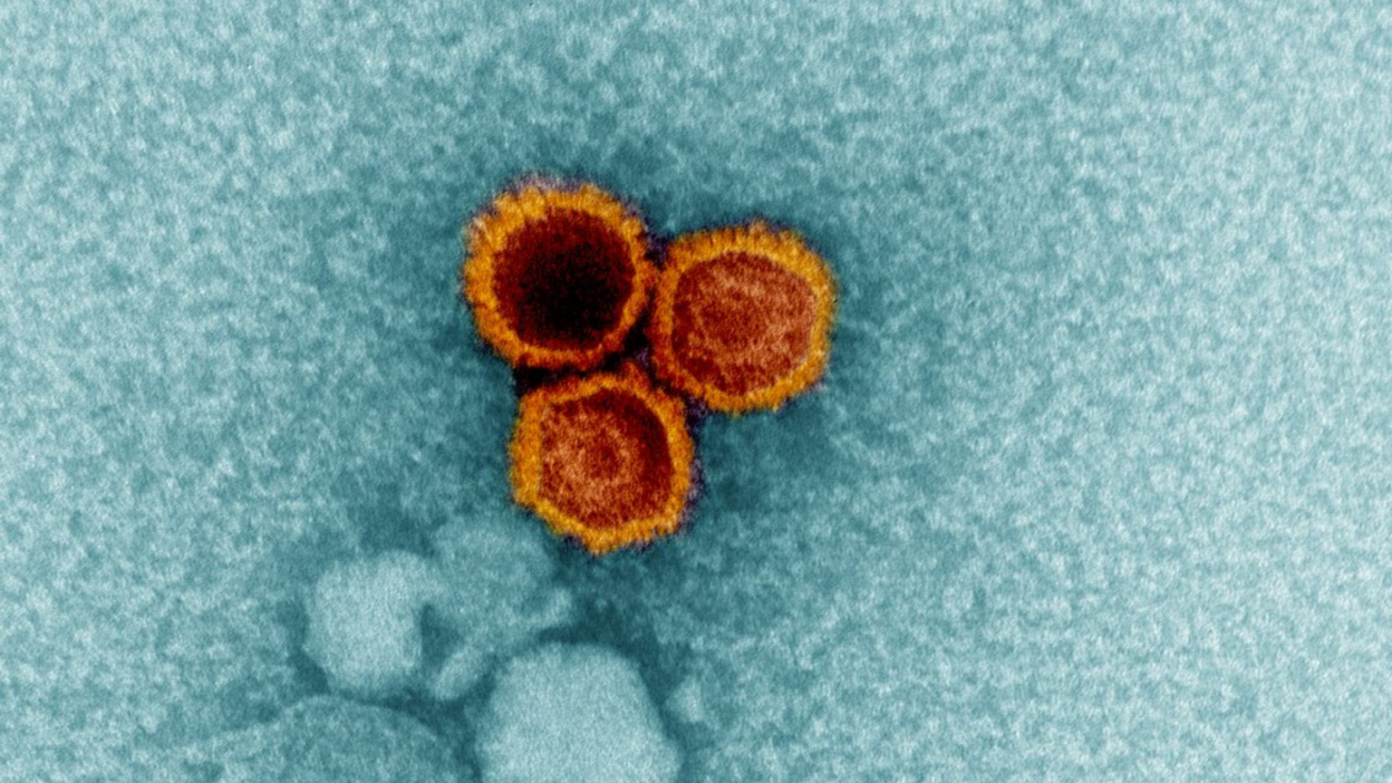 The “Kissing Disease” May Be Linked to a Much Bigger Health Risk Than Most People Realize