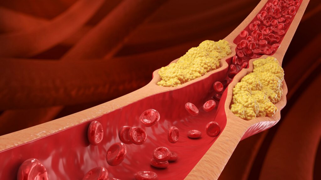 Illustration of an artery narrowed by yellow cholesterol plaque, with red blood cells flowing through the constricted vessel.